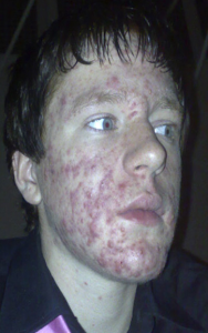 File:Acne.png