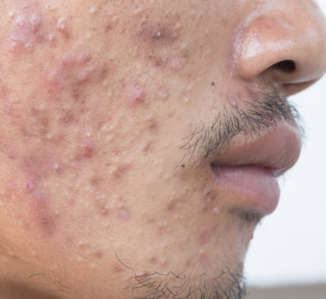 File:Acne royalty free.png